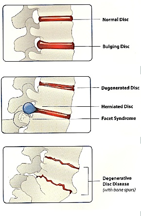Spinal Decompression | Mark Cymerint D.C.